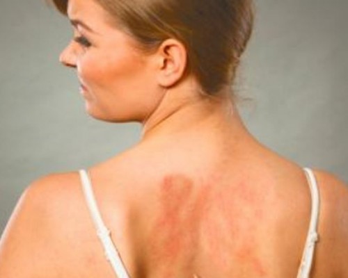 Una dintre cele mai necunoscute alergii: alergia la soare
