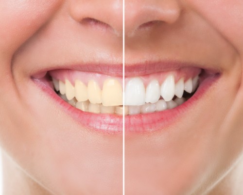 Invata cum sa iti protejezi corect dantura!  Reguli de “aur” in ingrijrea dintilor